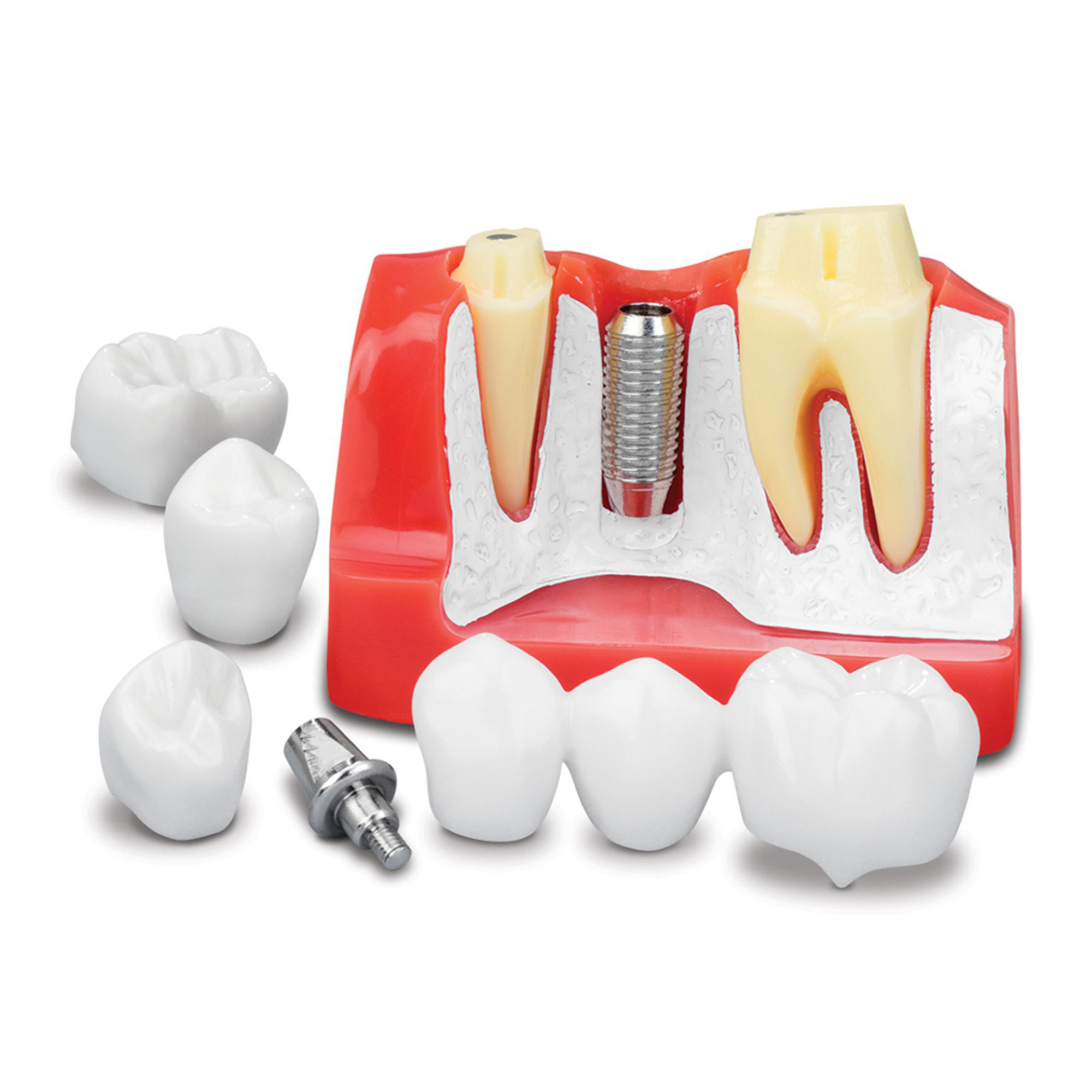 Implant Analysis Model To Explain Treatment Options. Demonstrate Dental Bridges, 7135611